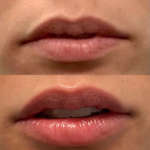 Restylane Kysse (lip-filler)