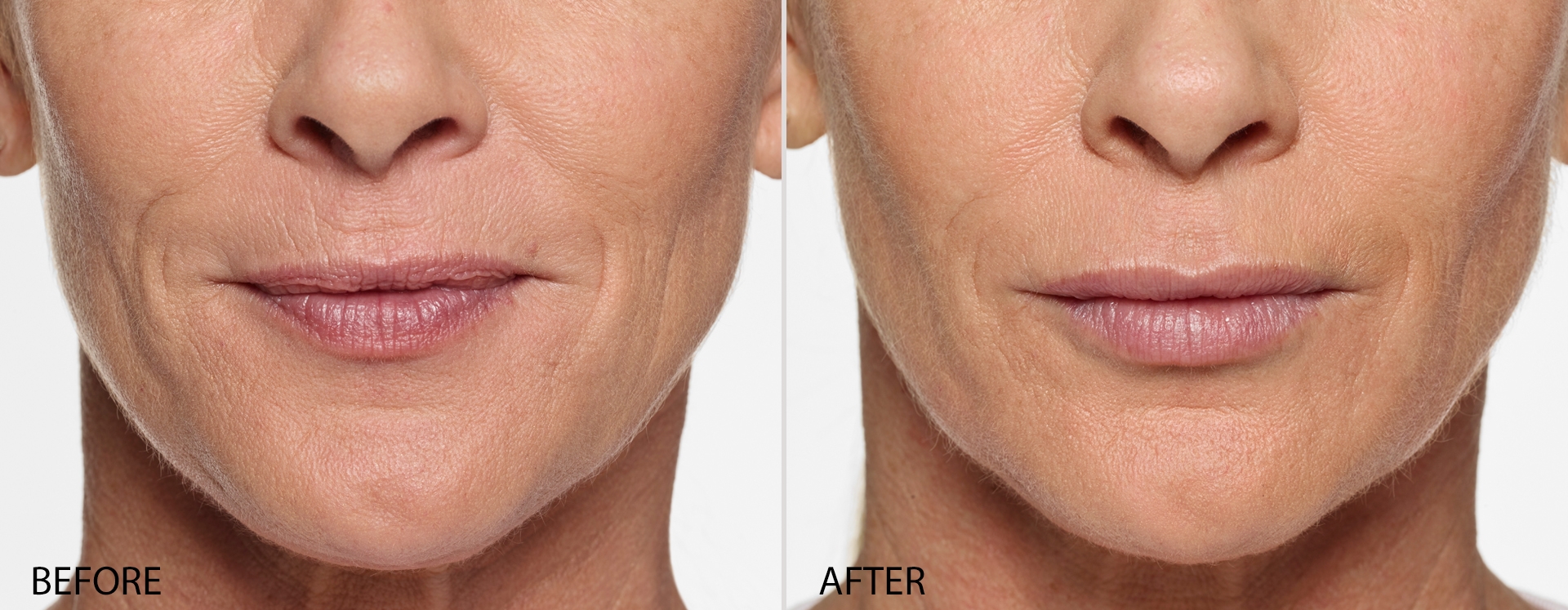 Restylane Silk Before and After 2016 Anne FF