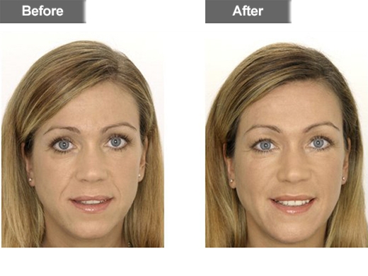 Restylane® clinical photo