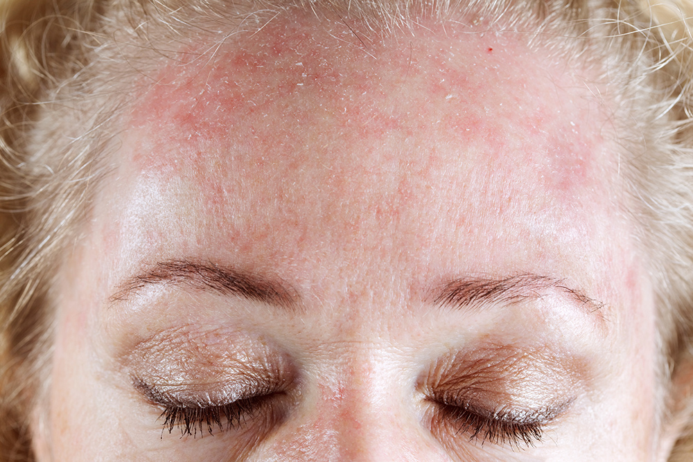 Seborrheic Dermatitis (Flaky/itchy skin)