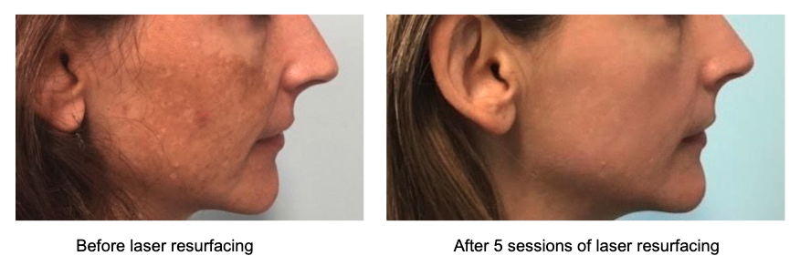 Skin Laser Resurfacing
