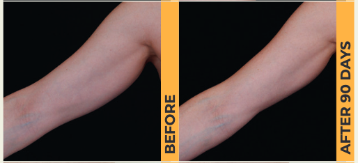 Ultherapy Prime Arms Treatment