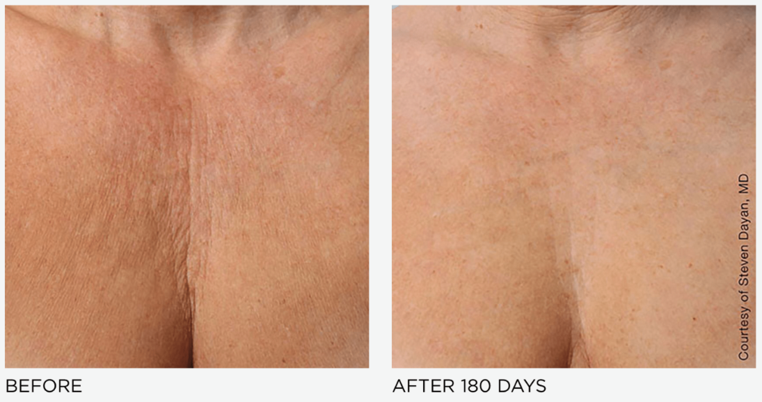 Ultherapy Prime Chest Treatment