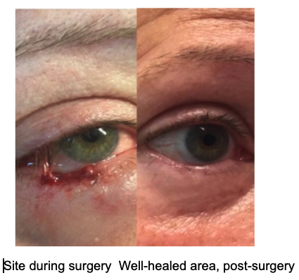 Basal cell carcinoma on or around the eye