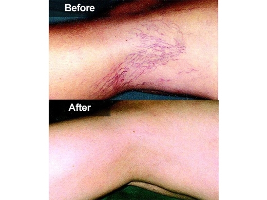 Broken-Capillaries-Diated-Blood-Vessels-040