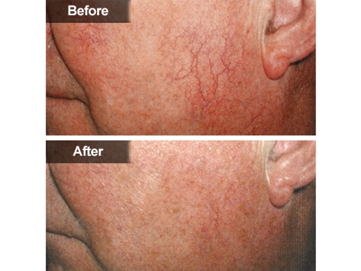 Broken-Capillaries-Diated-Blood-Vessels-050