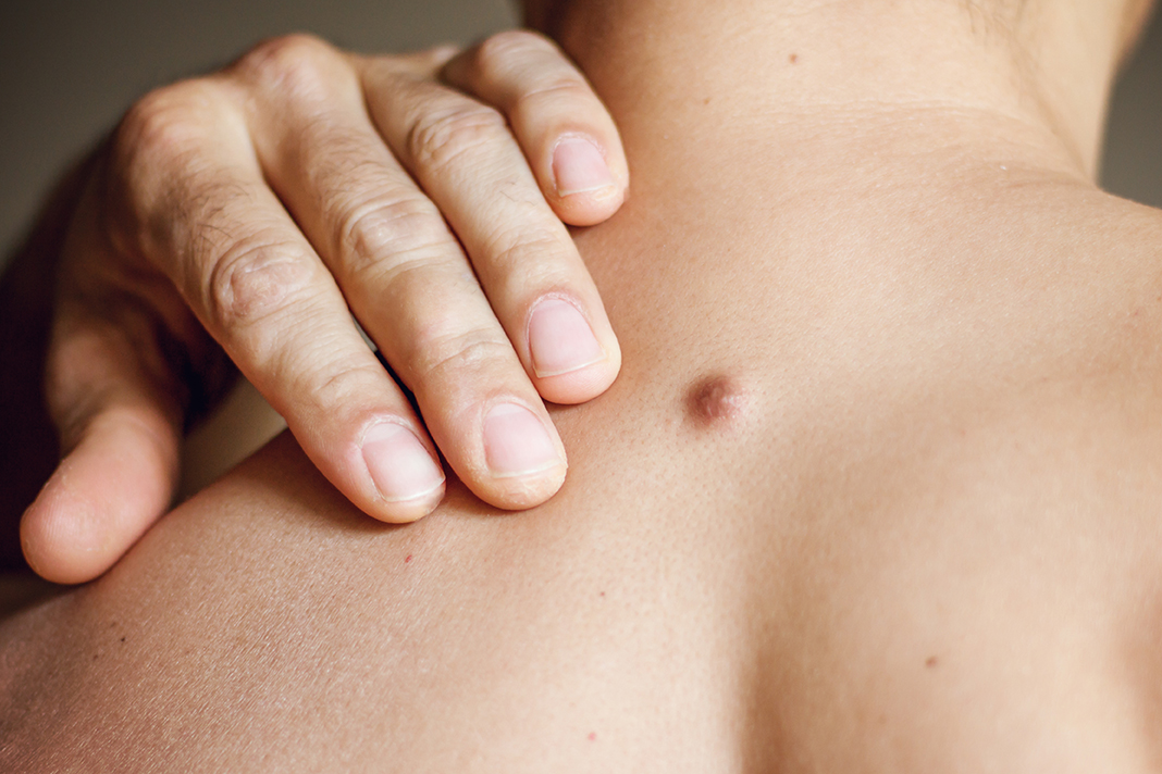 Cysts and Cyst Removal