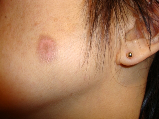 Hyperpigmentation-Melasma-010