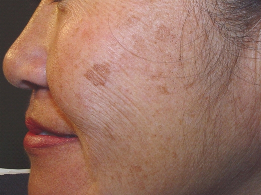 Hyperpigmentation-Melasma-020
