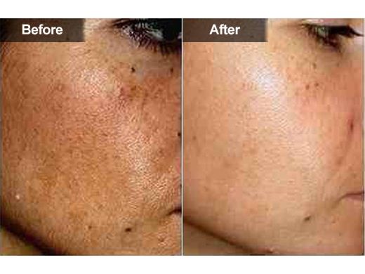 Hyperpigmentation-Melasma-050