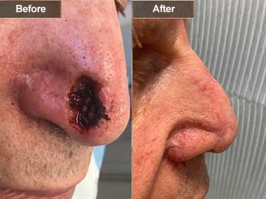 Mohs Surgery clinical photo