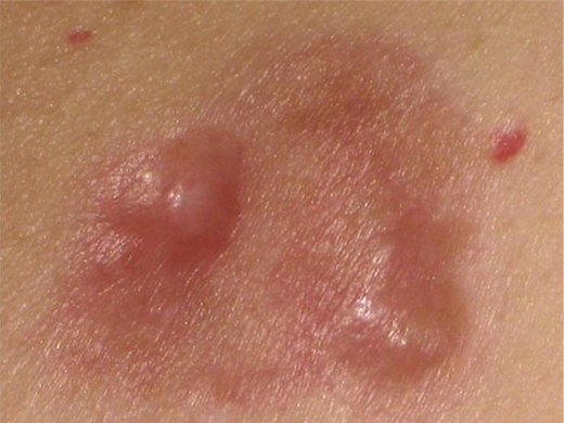Mohs Surgery clinical photo