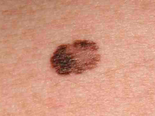 Moles, Atypical Moles & Melanoma clinical photo