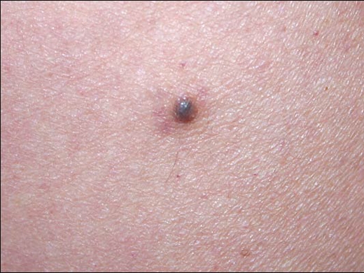 Moles, Atypical Moles & Melanoma clinical photo