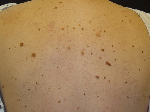 Moles, Atypical Moles & Melanoma clinical photo