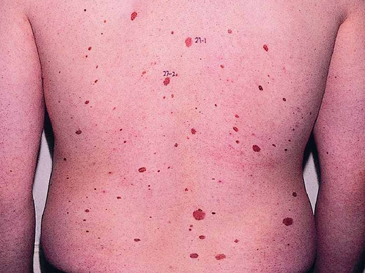 Moles, Atypical Moles & Melanoma clinical photo