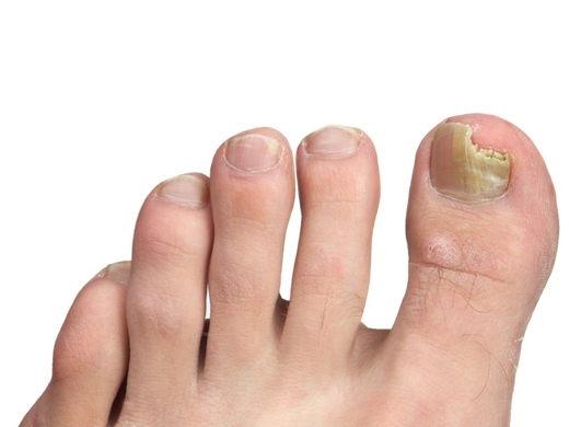 Nail Abnormalities clinical photo