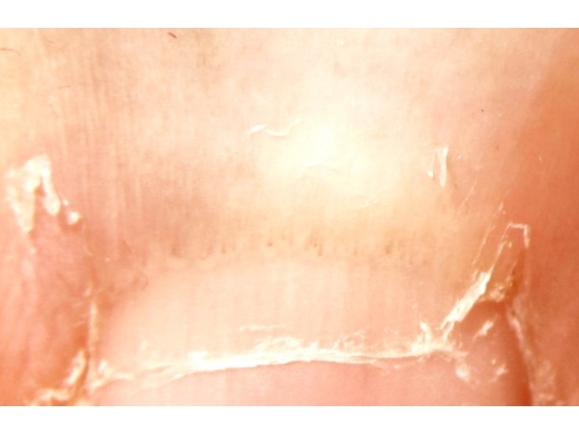 Nail Abnormalities clinical photo