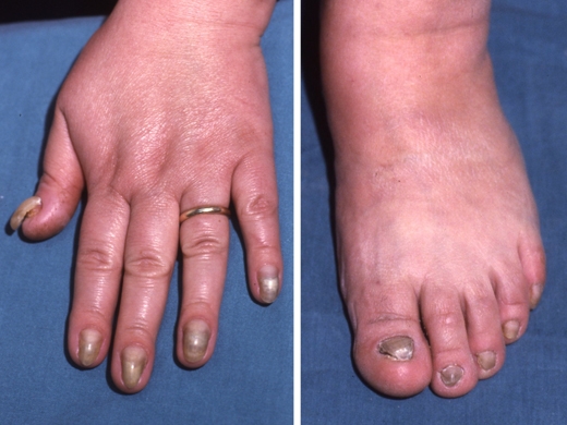 Nail Abnormalities clinical photo