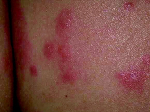 Rashes clinical photo