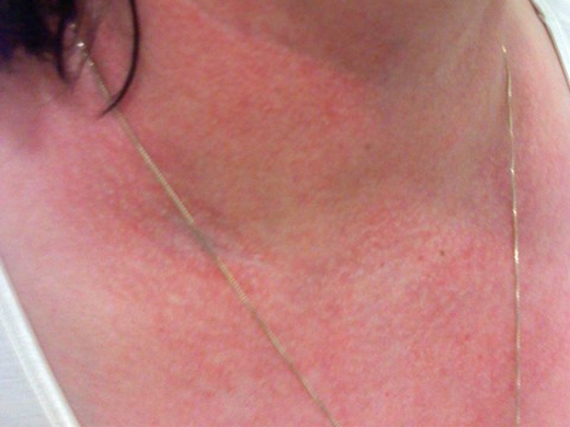 Rashes clinical photo