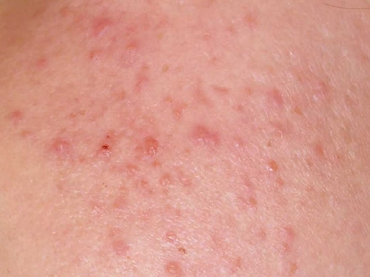 Rosacea Specialist clinical photo