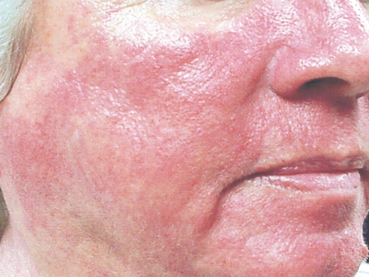 Rosacea Specialist clinical photo