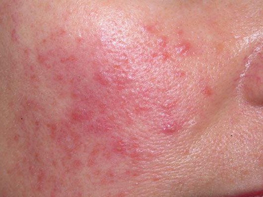 Rosacea Specialist clinical photo