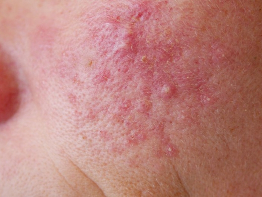 Rosacea Specialist clinical photo
