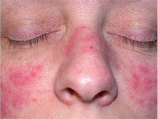 Rosacea Specialist clinical photo