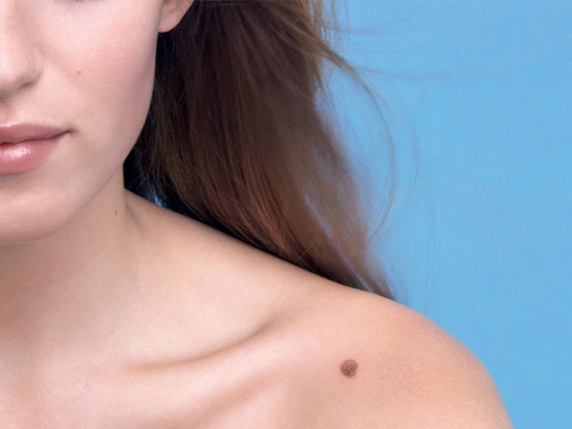 Skin Cancer Detection clinical photo