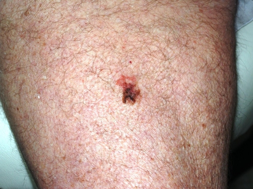Skin Cancer Detection clinical photo
