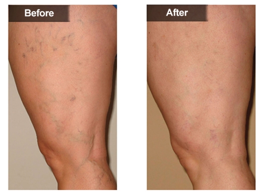 Spider Veins clinical photo