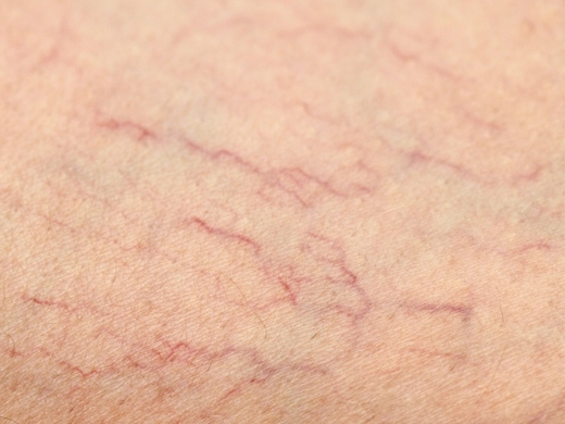 Spider Veins clinical photo