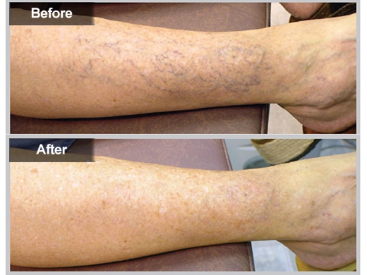 Spider Veins clinical photo