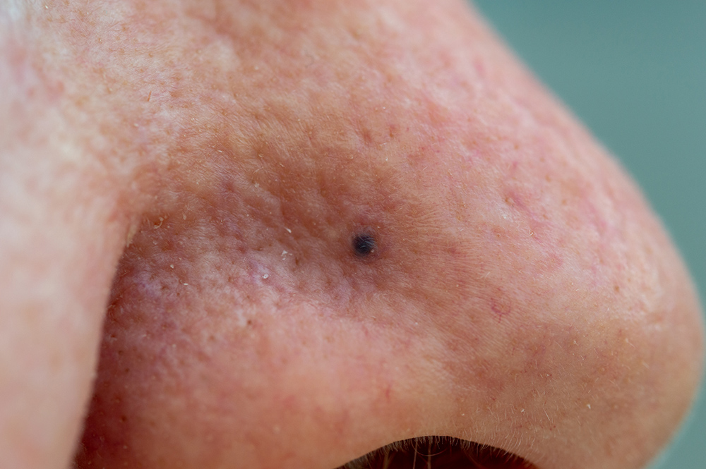 Traumatic Tattoo Removal
